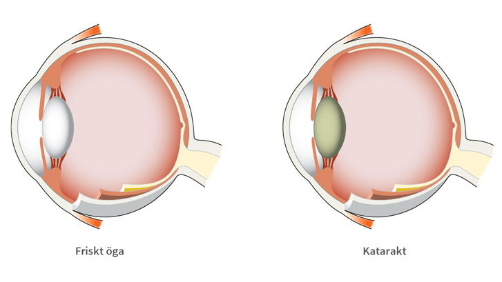 Katarakt gör linsen grumlig och ogenomskinlig.