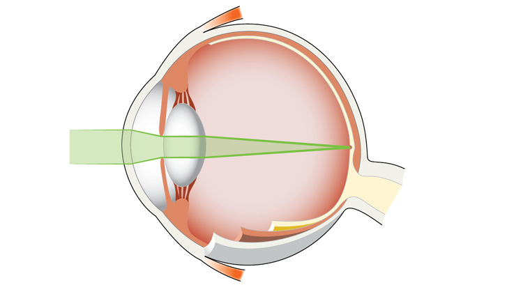 Vid normal syn bryts ljusstrålarna till en punkt på näthinnan.