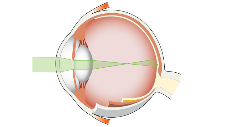 Vid närsynthet bryts ljusstrålarna framför näthinnan.