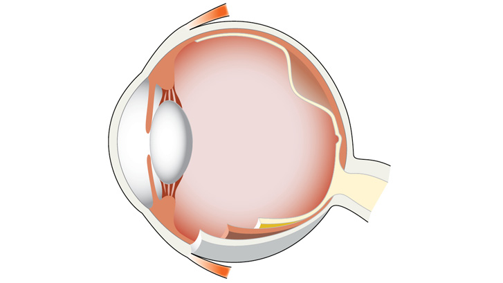 Näthinneavlossning innebär att näthinnan lossnar från sina fästen mot åderhinnan.